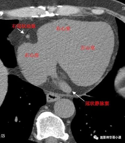 【高清ct图】心脏冠脉cta解剖