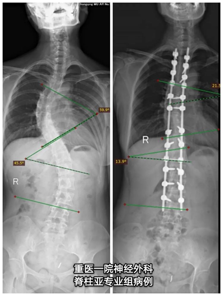 病例分享成人脊柱侧弯畸形一例