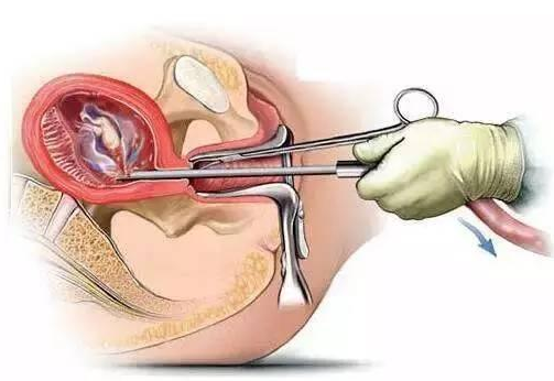 如何避免人工流产对子宫造成的伤害?答案在这里