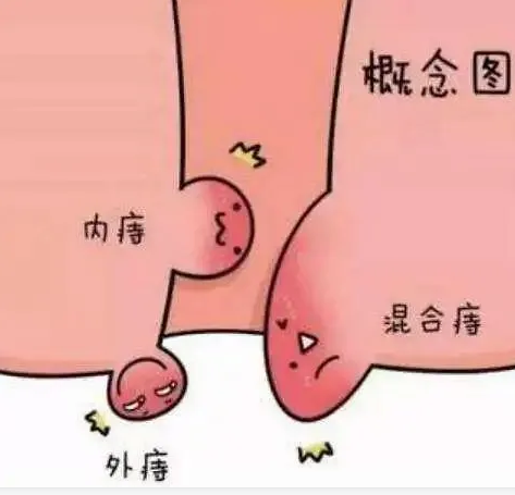 痔疮出血的处理方法?
