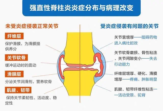 强直性脊柱炎的症状有哪些强直性脊柱炎怎么治