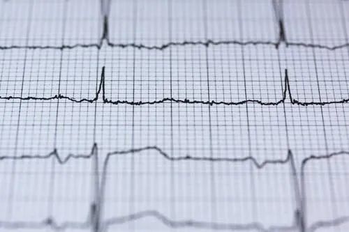 体检查出"窦性心律"是啥意思?心律不齐是心脏病吗?可算明白了