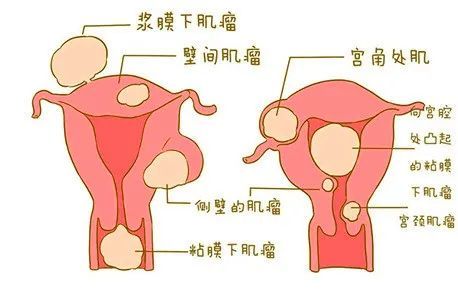 (2)浆膜下肌瘤:肌瘤向子宫浆膜面生长,并突出于子宫表面,肌瘤表面仅由