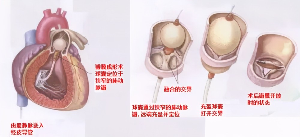 宝宝活动后胸闷,气短,耐力差,微创介入巧治肺动脉瓣狭窄