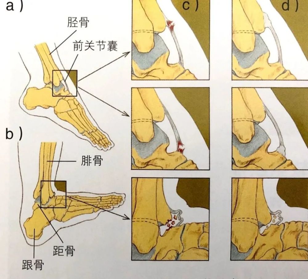 当向上屈曲脚踝时的被动过伸,即背屈;c.急性期可能存在的损伤;d.
