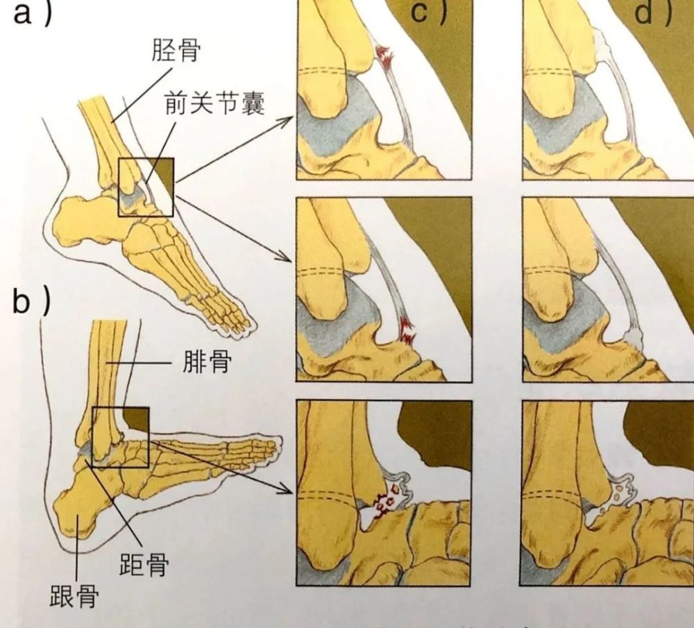 图示:足球踝:对踝关节骨关节改变的可能的解释.a.