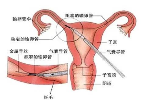 维系生命之桥解析输卵管不孕的诊断和治疗