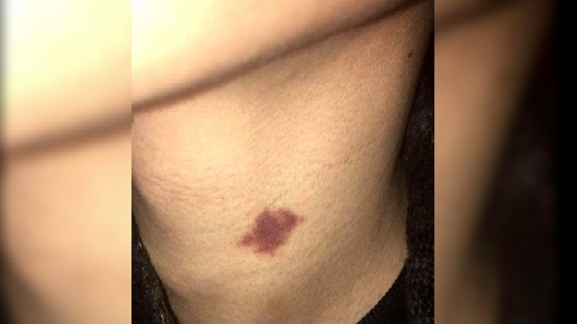 脖子上出现吻痕女友一怒之下要分手男子我这是睡出来的睡前嘿嘿嘿