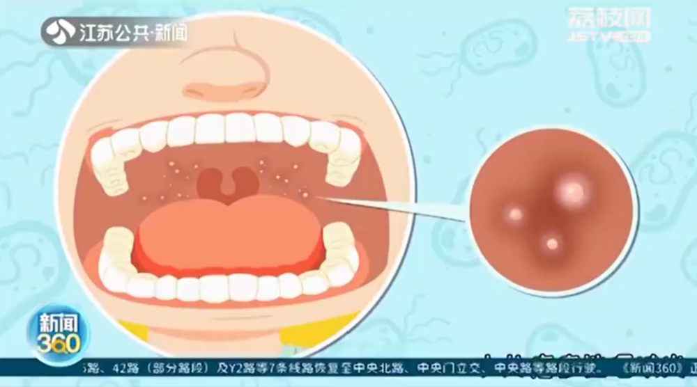 孩子咽颊部长了小水泡别大意可能是这种病