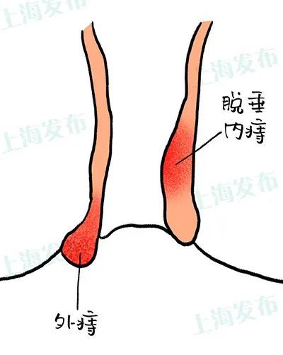 会脱出肛门口(肛门块物脱出) 一开始,还可以自行缩回 但慢慢地就需要