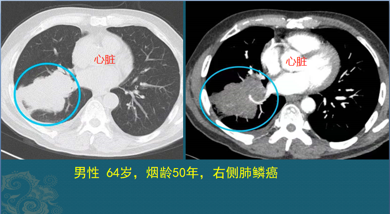 这是一张肺癌病人的ct片子,这位病人有点遗憾也有点幸运!