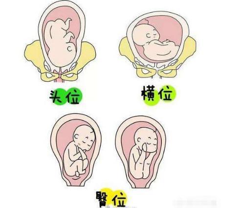 产检时发现胎位不正怎么办呢云南协美主任