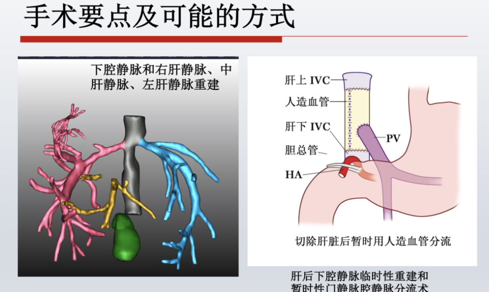 "阿姨,你得了肝癌,我把你整个肝都掏出来了.