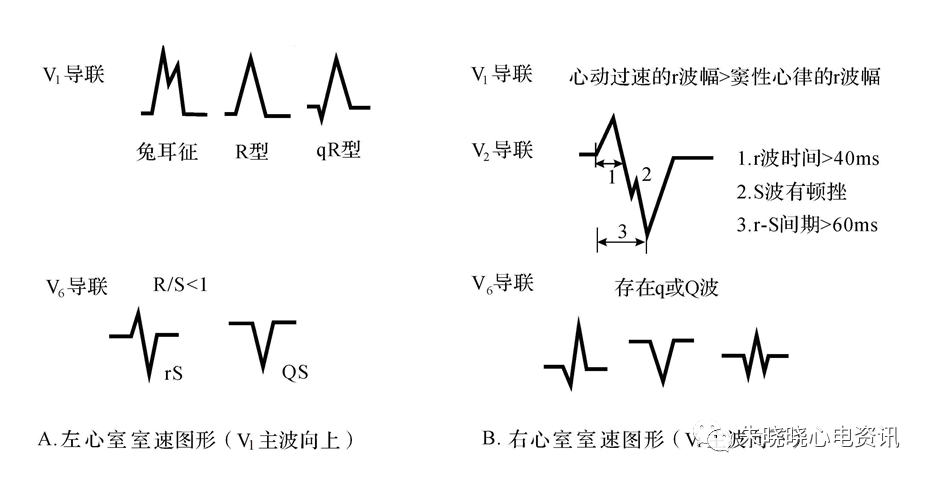 其心电图表现为类左束支阻滞图形,也存在着"右3左1"的特征:即右胸v1或
