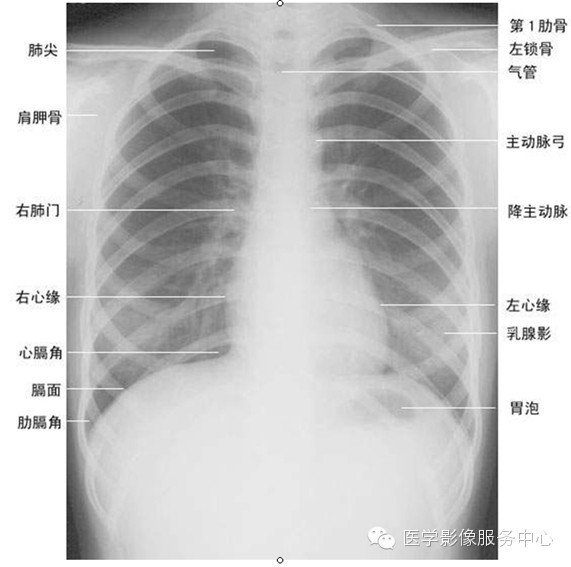 胸椎:在投照条件较底的胸片,肿瘤,结核易漏诊,注意观察椎体形态及有无
