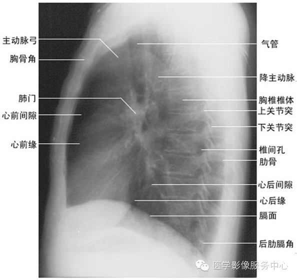 肺门:肺门较小的肿块有时需与扩张的肺动脉,左肺动脉弓鉴别;10.