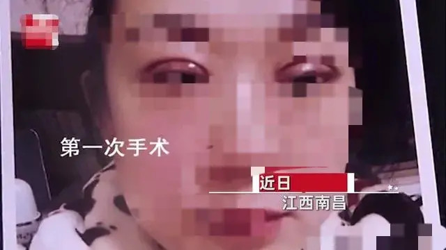 江西南昌一女子因整形手术失败 导致老公闹离婚