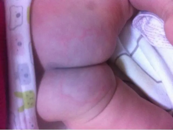 宝妈一定要定期的观看宝宝的臀部,是否出现发红或者溃烂.