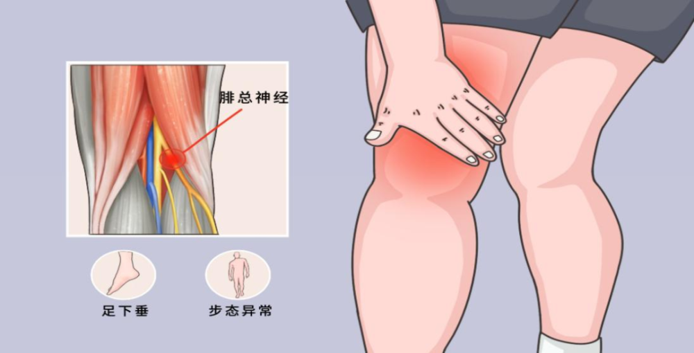 腿部症状勿忽视可能是腓总神经损伤