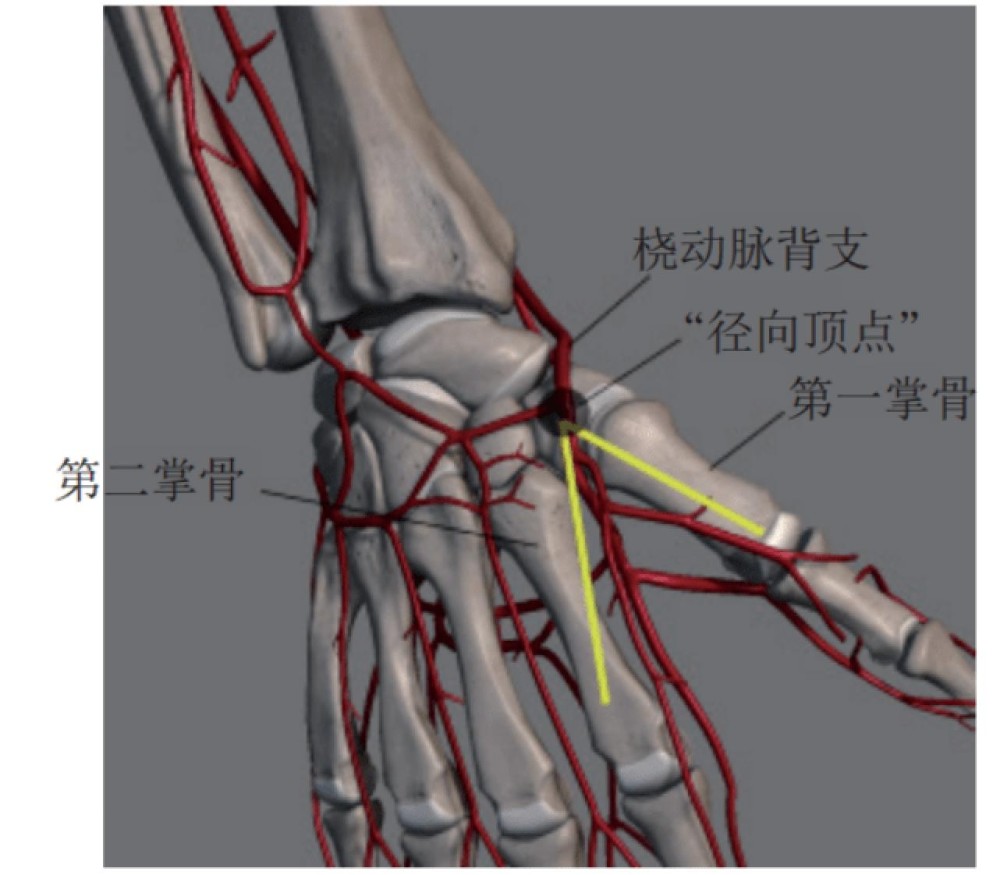 自治区首例经远端桡动脉路径行冠状动脉介入诊疗