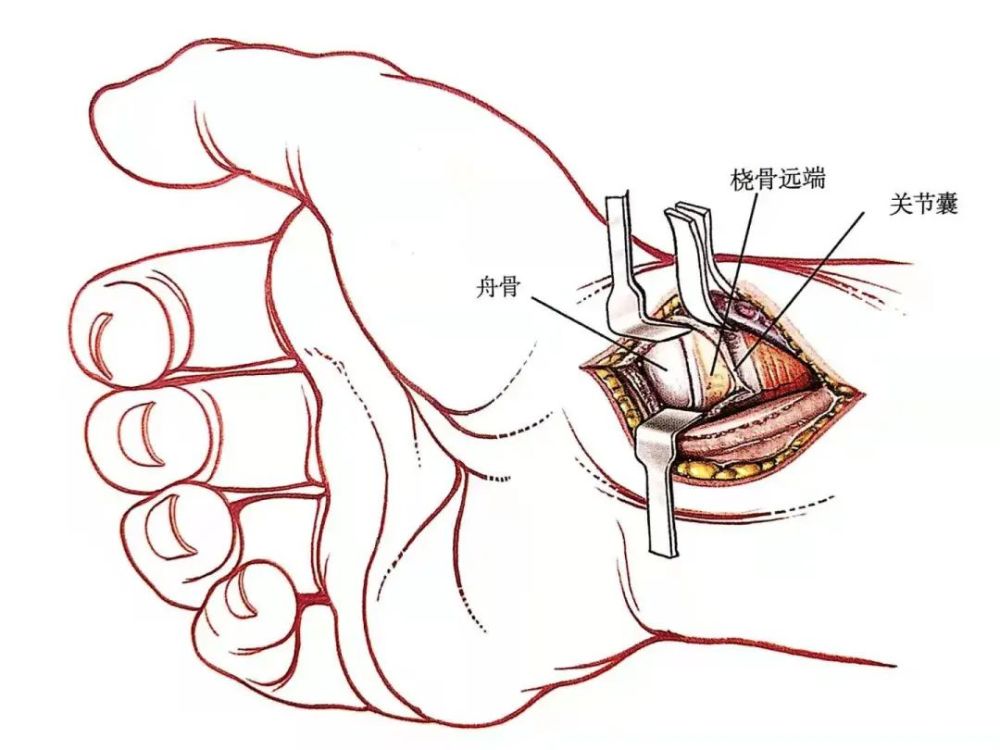 【骨科小技巧】舟骨骨折的掌侧入路技巧!