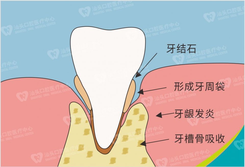 怎么预防和去除牙结石?