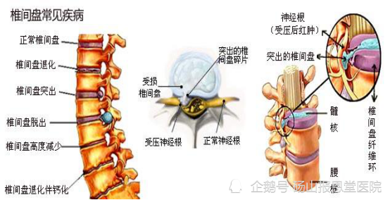 腰间盘突出的过程和影响腰间盘突出的因素