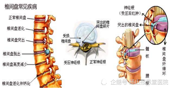 2,下肢放射痛:虽然高位腰椎间盘突出(腰2～3,腰3～4)