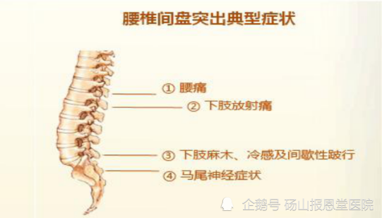 腰间盘突出的过程和影响腰间盘突出的因素