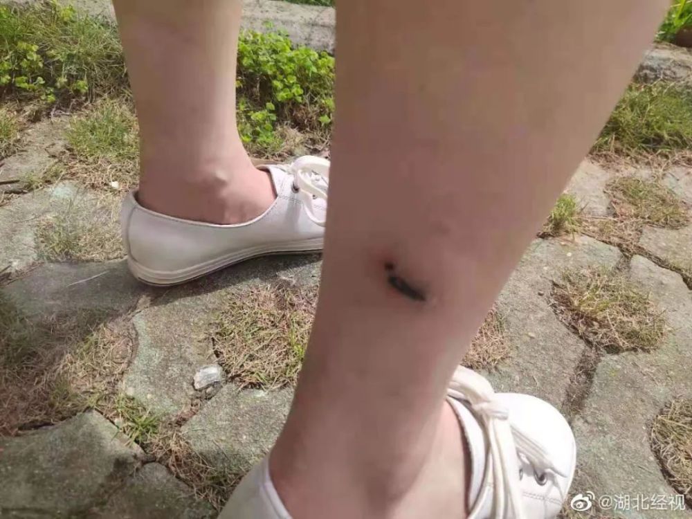万一不幸被狗抓咬,如何处理?