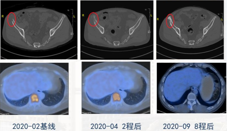 起始应用,实力尽显:地舒单抗优越疗效,助力肺癌骨转移持续获益