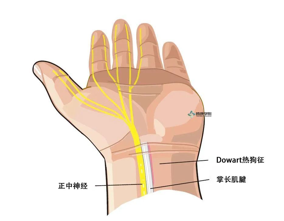 疼痛解剖学|腕管综合征:dowart热狗征