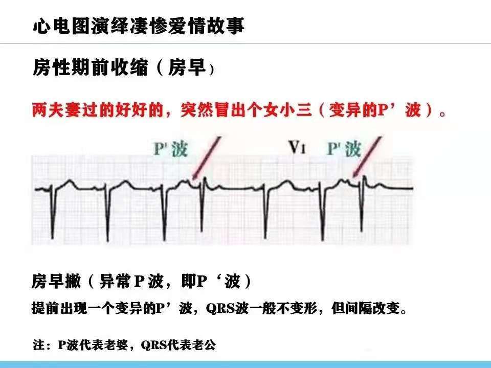 用凄惨的爱情故事来学习常见心电图,易理解,好记忆,久久不忘