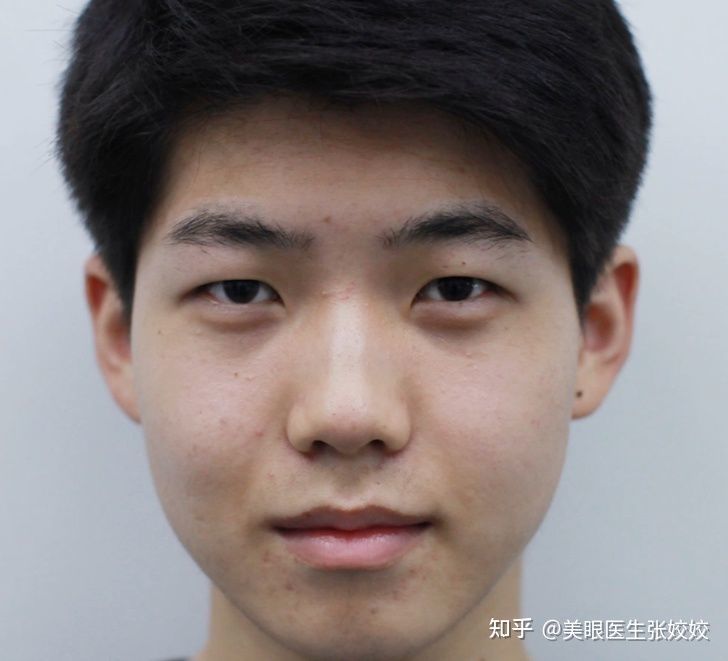 男生做双眼皮手术是什么体验