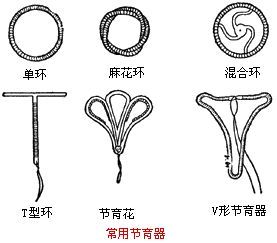 1,节育环的种类在80,90年代,为了响应国家计划生育的政策,几千万的