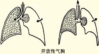 一文带你了解,气胸这种会呼吸的痛