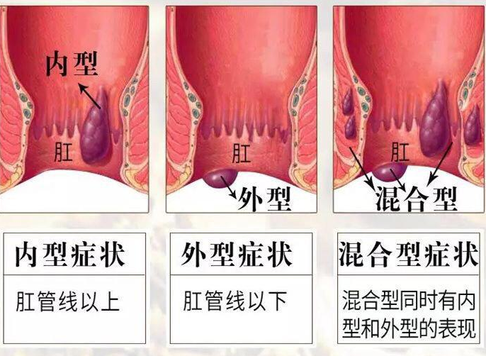 研究发现o型血的人天生容易得痔疮