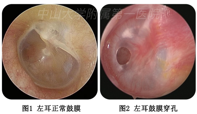 听力下降,耳痛难耐…耳朵鼓膜穿孔怎么办?专家来支招!