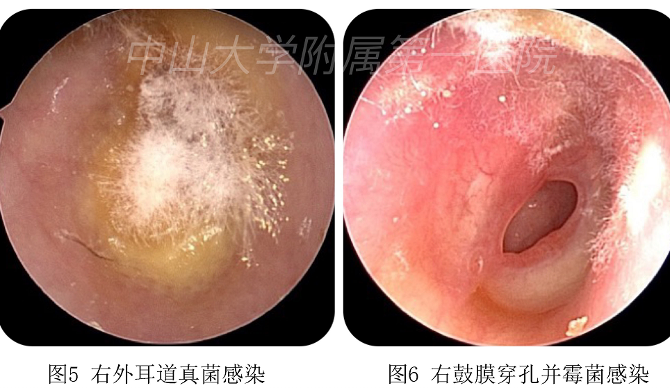 听力下降耳痛难耐耳朵鼓膜穿孔怎么办专家来支招