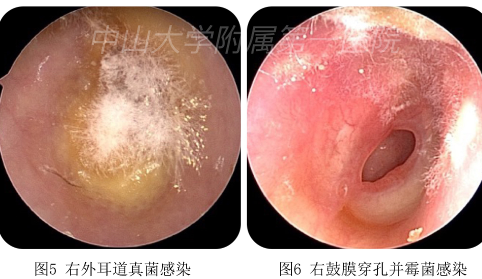 本次起病由于长期应用抗生素药水滴耳,导致外耳道真菌感染.