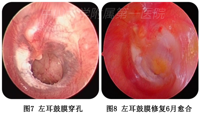 听力下降,耳痛难耐……耳朵鼓膜穿孔怎么办?专家来支招!