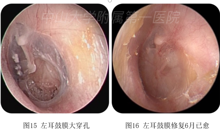 听力下降,耳痛难耐……耳朵鼓膜穿孔怎么办?专家来支招!