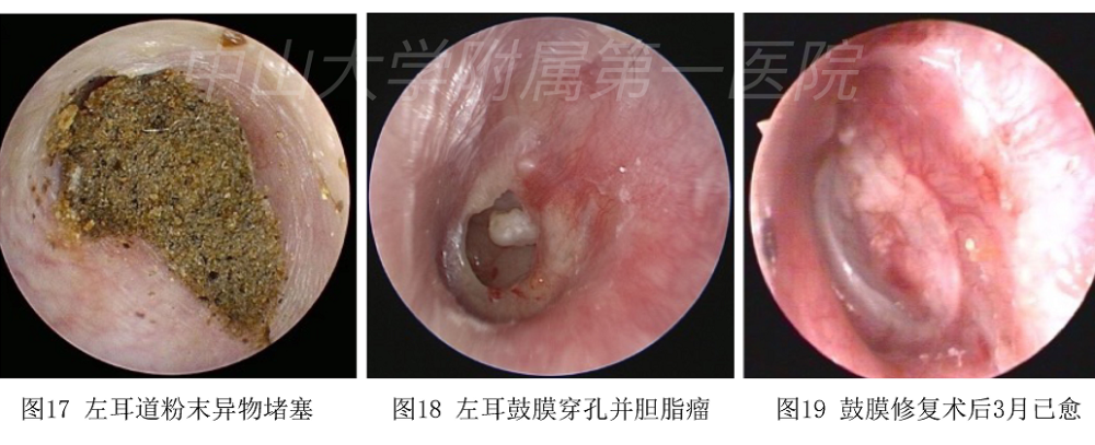 听力下降耳痛难耐耳朵鼓膜穿孔怎么办专家来支招