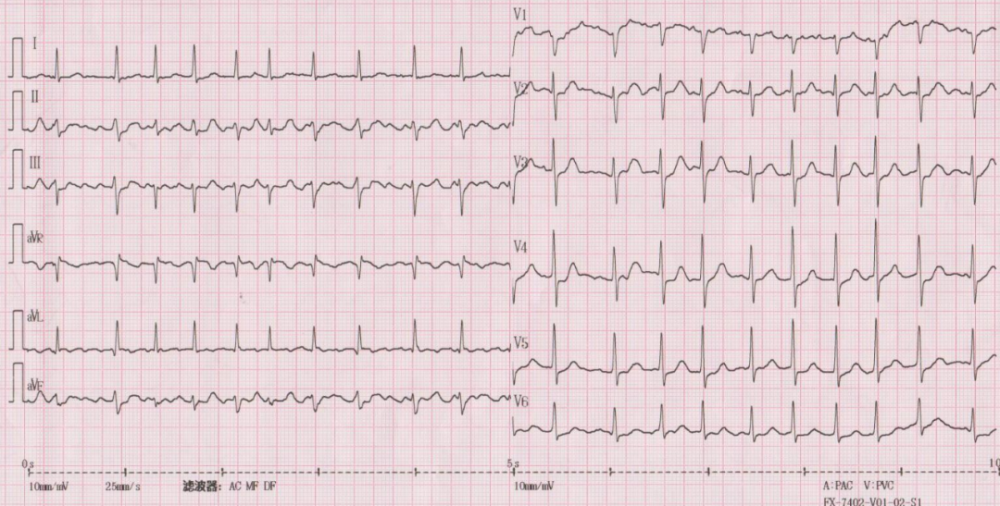 从一张普通心电图,去参透心悸的机密|深度解析