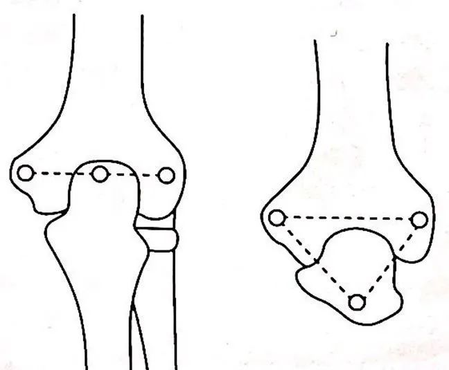 图6 肘后三角 图7:米尔(mill)征 (4)肘侧副韧带稳定试验:肘关节在