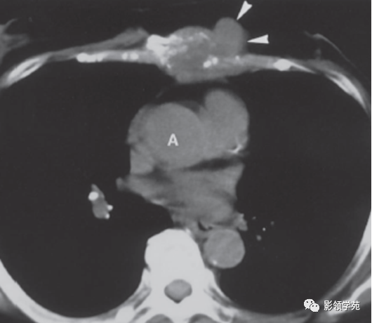 胸壁肿瘤的ct诊断