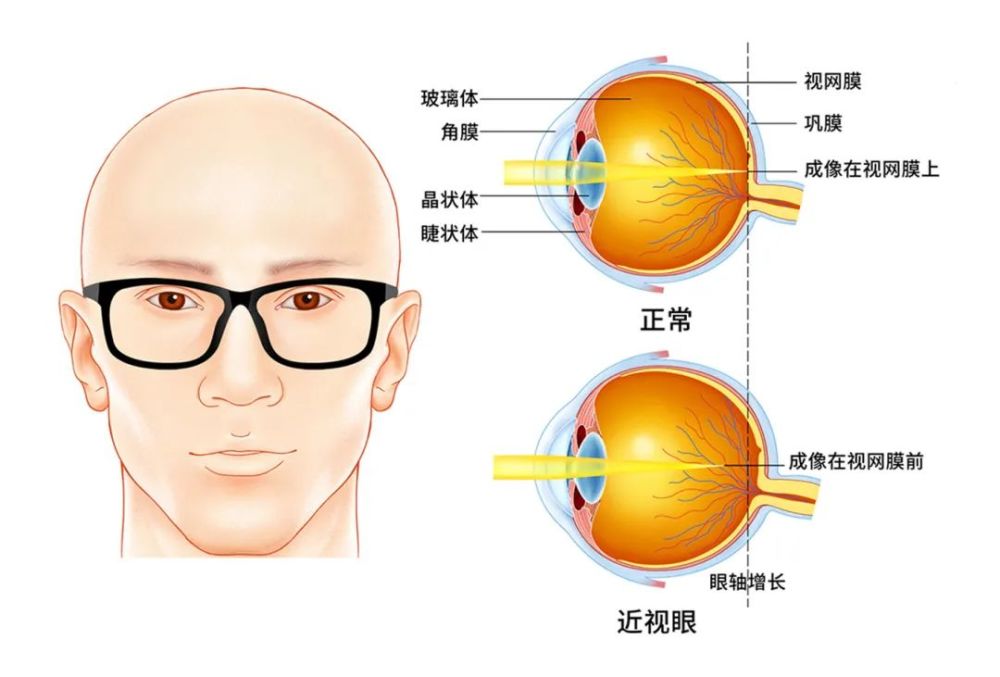 近视眼 很多人都偏爱朦胧美 迷恋那种看不透,摸不着的感觉 但如果你