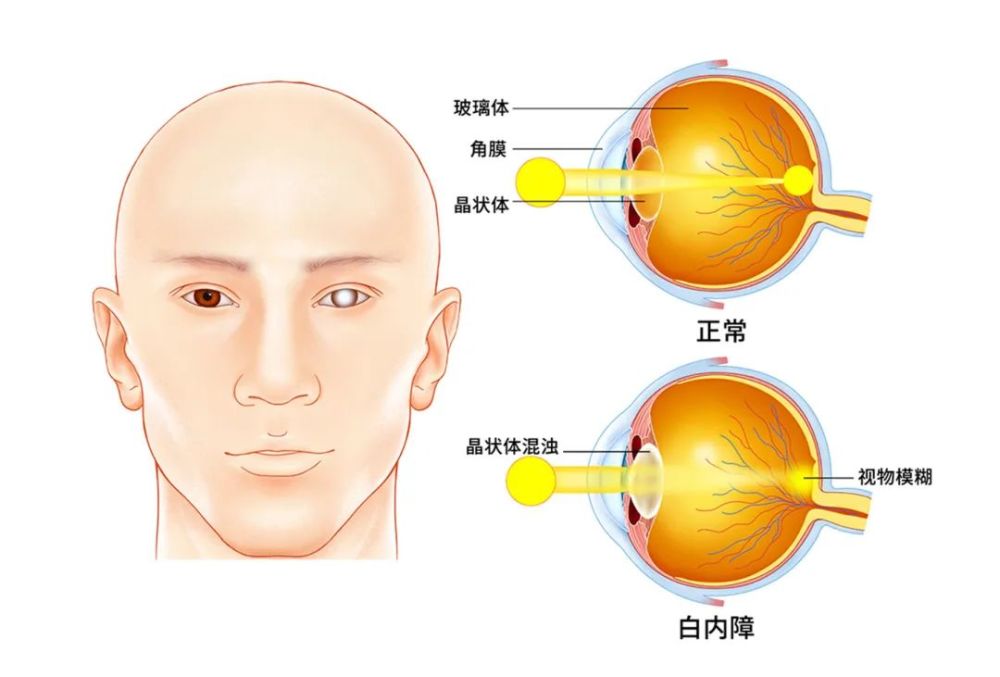 的可能 白内障 晶状体是人眼球中的重要光学部件 正常情况下是透明的