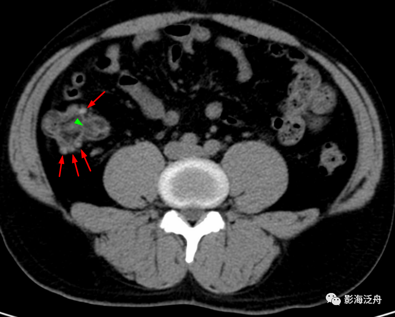 多数盲肠憩室炎病例可以见到相对正常的阑尾,而能否在ct图像上找到