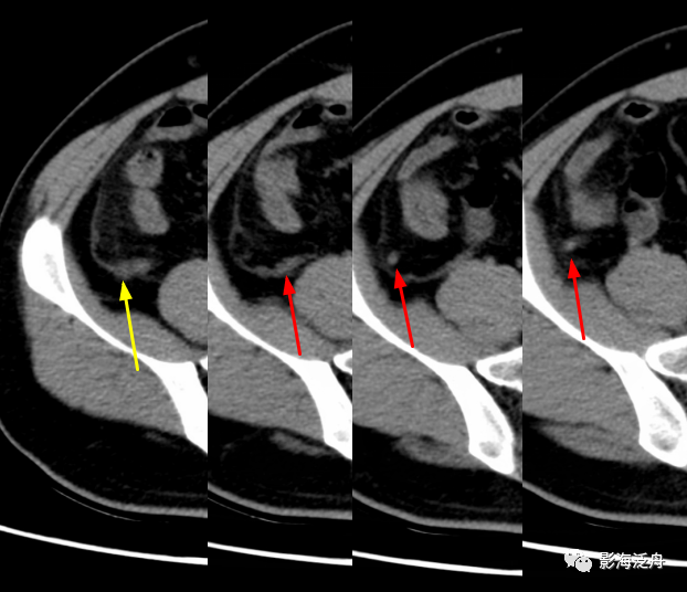 在影像表现上也及其相似,再加上阑尾本身在影像上就难以寻找,因此二者